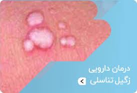 درمان قطعی زگیل تناسلی خانمها و آقایان