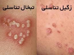 درمان قطعی زگیل تناسلی خانمها و آقایان