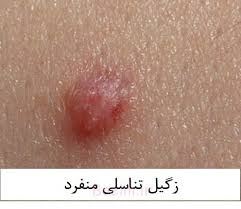 درمان قطعی زگیل تناسلی خانمها و آقایان