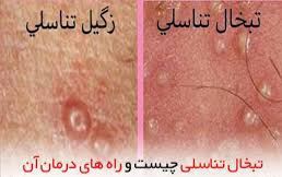درمان قطعی زگیل تناسلی خانمها و آقایان