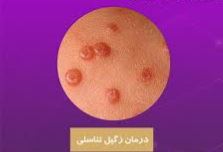 درمان قطعی زگیل تناسلی خانمها و آقایان