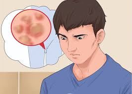 درمان قطعی زگیل تناسلی خانمها و آقایان