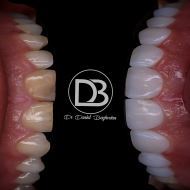 لمینت دندان در زرین شهر