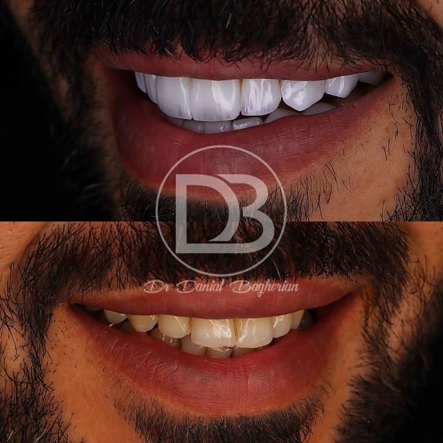 لمینت دندان در زرین شهر