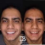 کامپوزیت دندان در زرین شهر