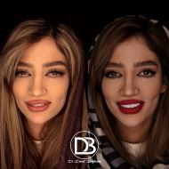 لمینت دندان در زرین شهر