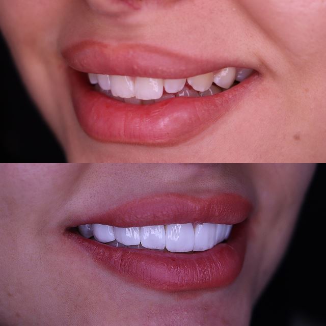 لمینت دندان در فولادشهر