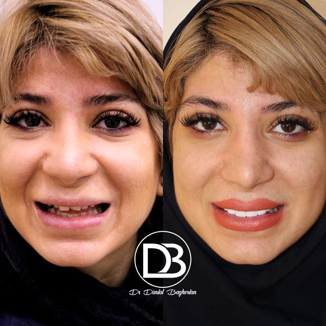 لمینت دندان در فولادشهر