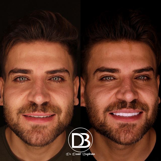 کامپوزیت دندان در فولادشهر