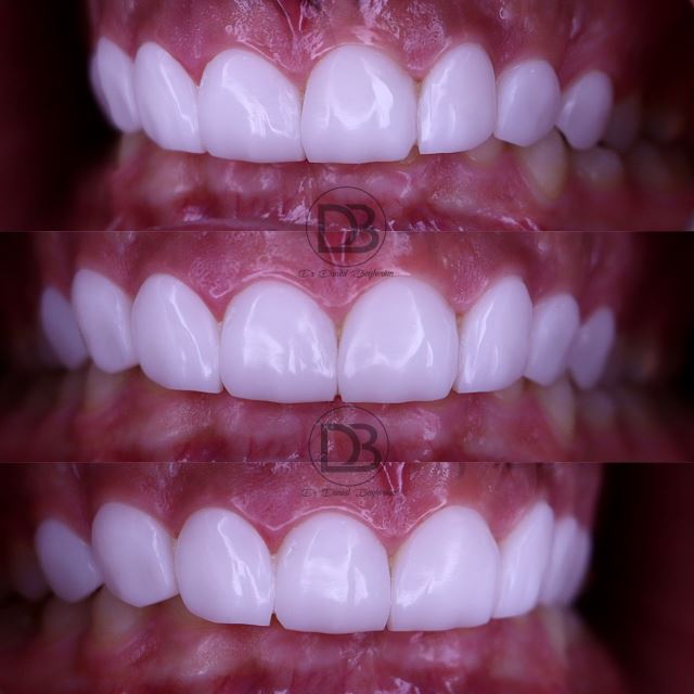 لمینت دندان در شهرکرد