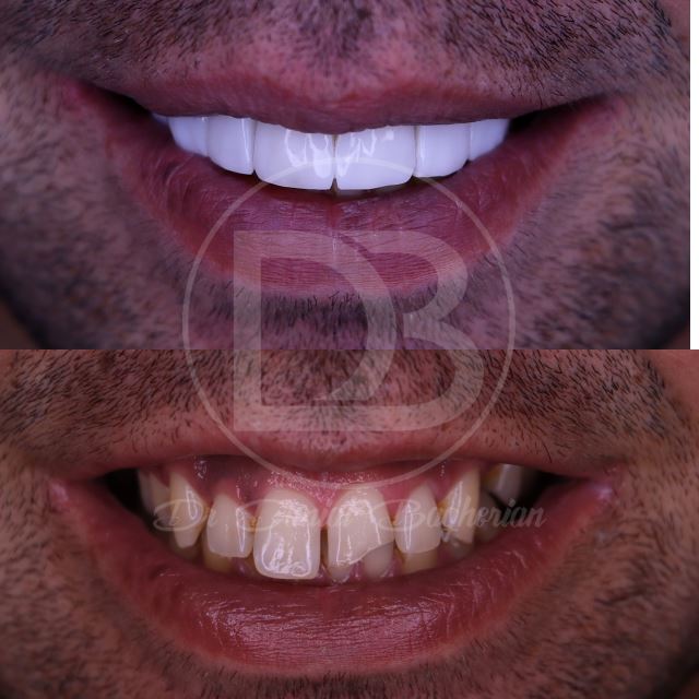 لمینت دندان در شهرکرد