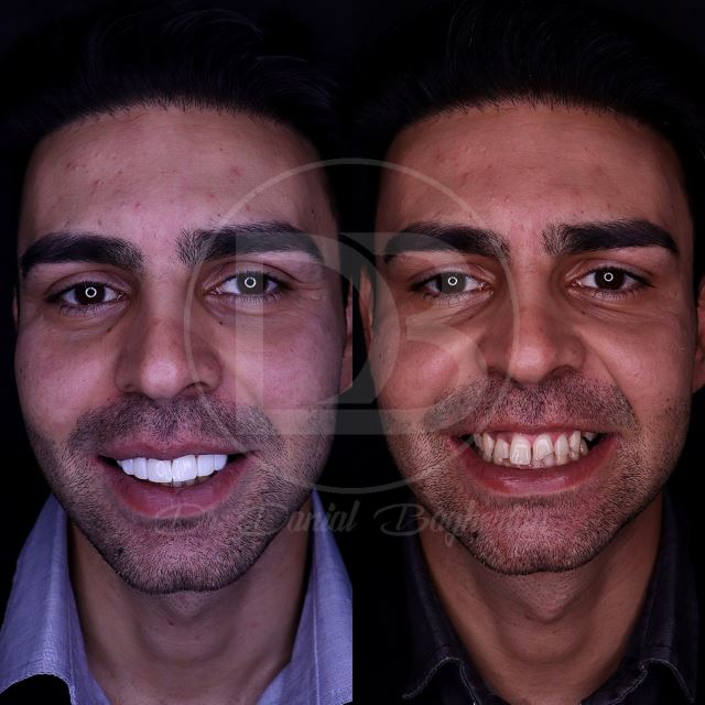 لمینت دندان در شهرکرد