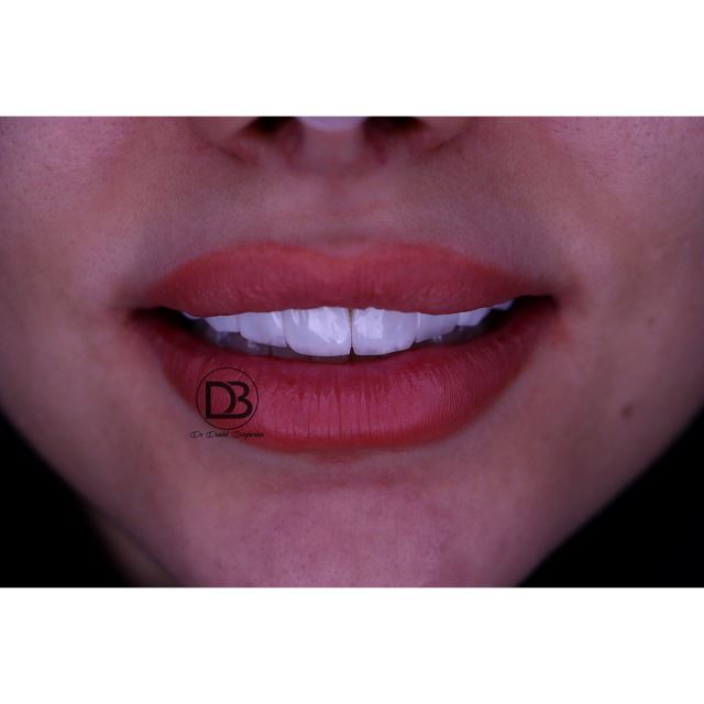 لمینت دندان در شاهین شهر