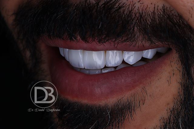 بهترین نوع لمینت چیست