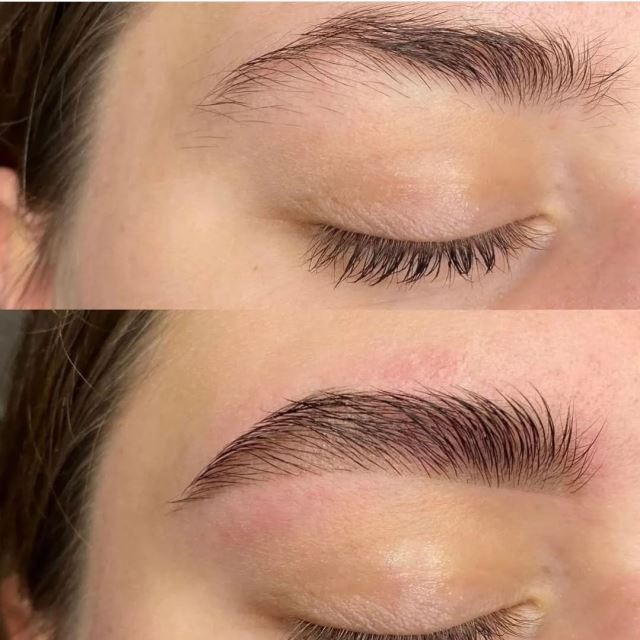 خدمات لیفت ابرو در تهران