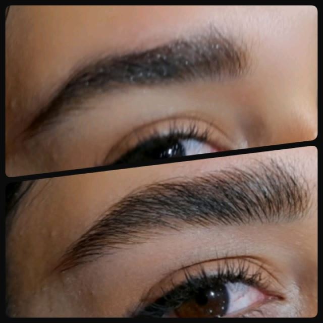 قیمت لیفت ابرو در تهران