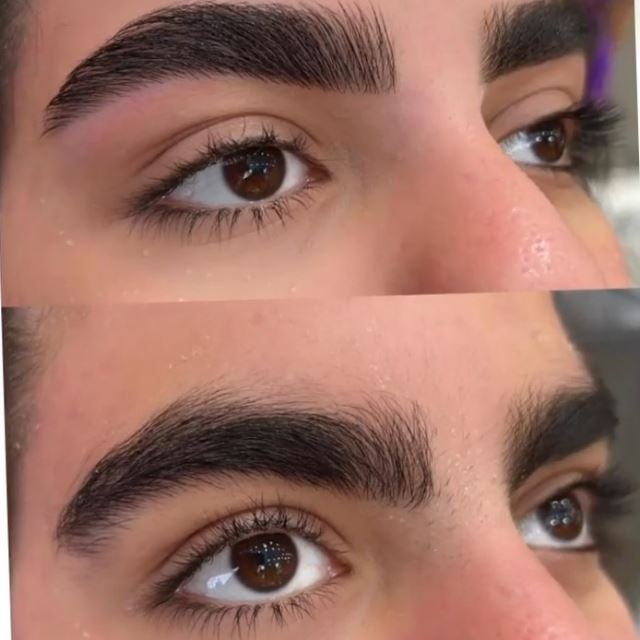 خدمات لیفت ابرو در تهران