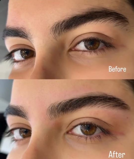 لیفت تخصصی ابرو در تهران