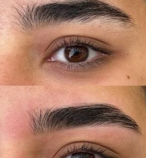 قیمت لیفت ابرو در تهران