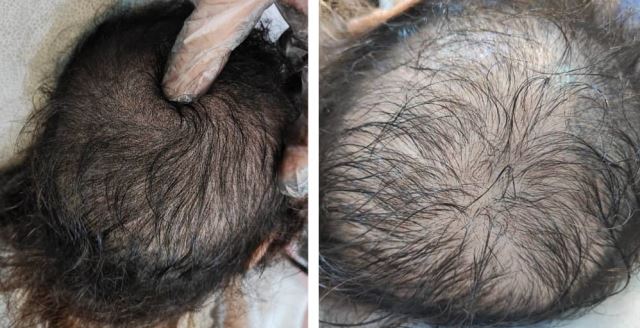 میکرواسکالپ سر