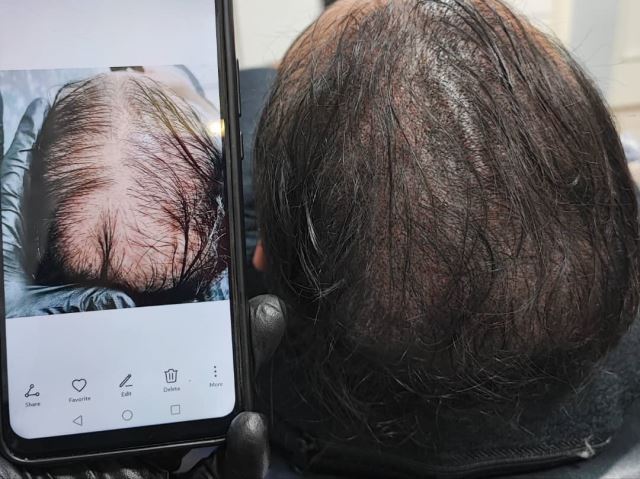 میکرواسکالپ سر