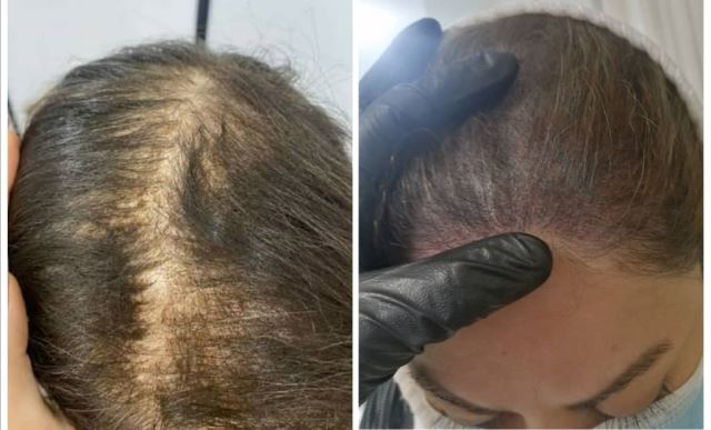 میکرواسکالپ سر