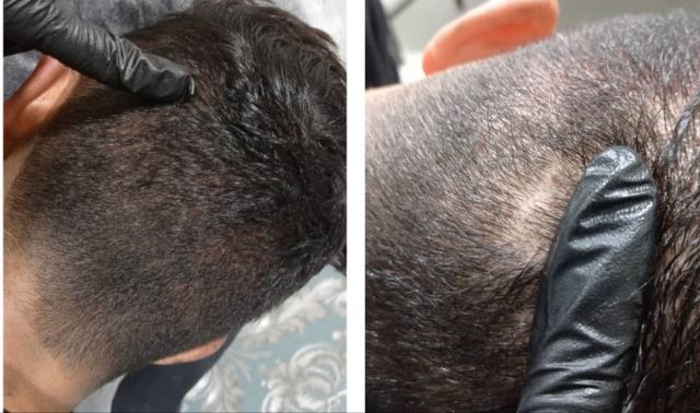 میکرواسکالپ سر