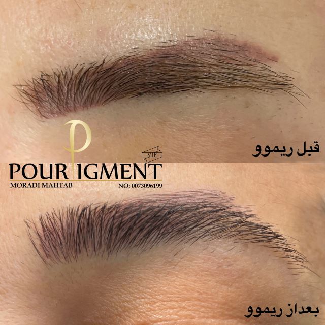 ریموو تخصصی