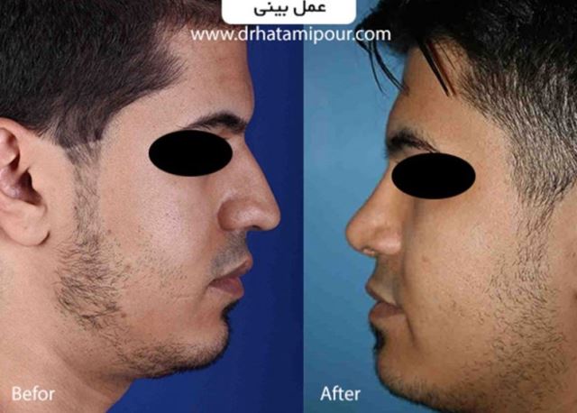 بهترین جراح بینی در شیراز