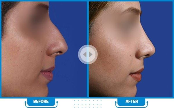 بهترین جراح بینی در شیراز