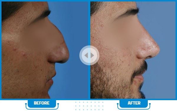 بهترین جراح بینی در شیراز