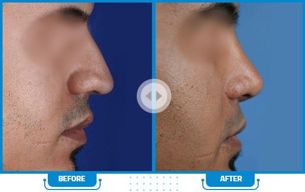 بهترین جراح بینی در شیراز