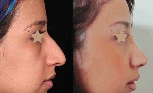 بهترین جراح بینی در شیراز