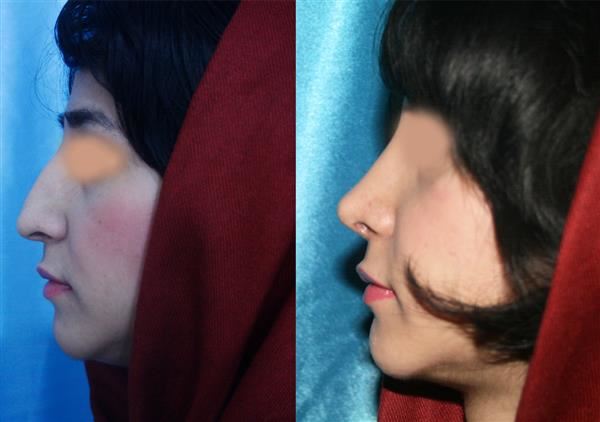 بهترین جراح بینی در شیراز