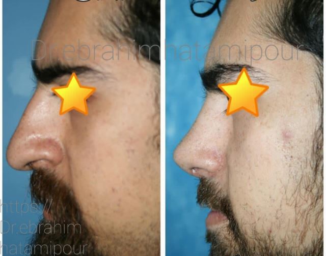 بهترین جراح بینی در شیراز