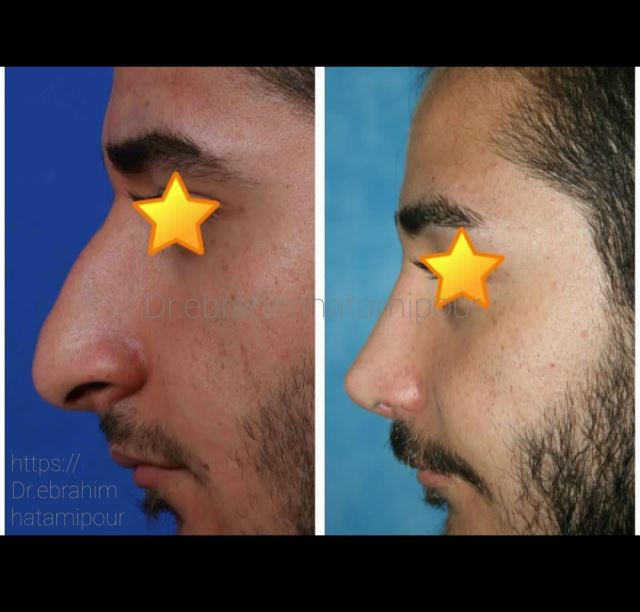 بهترین جراح بینی در شیراز