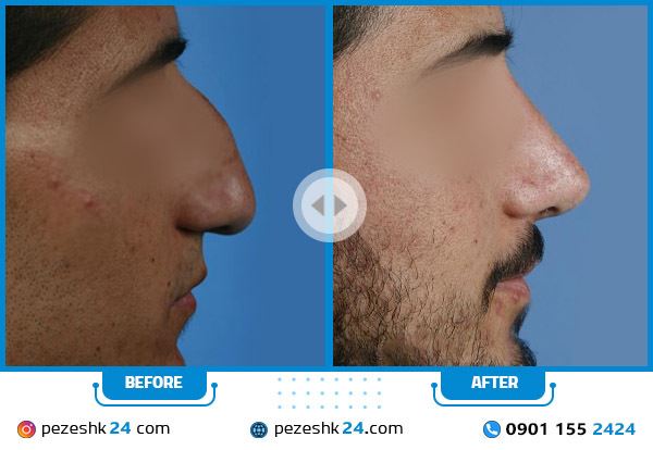 بهترین جراح بینی در شیراز