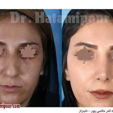 بهترین جراح بینی در شیراز