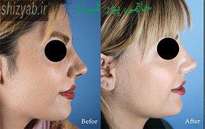 بهترین جراح بینی در شیراز