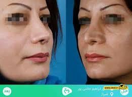 بهترین جراح بینی در شیراز