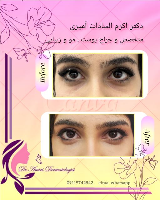 فیلر زیر چشم