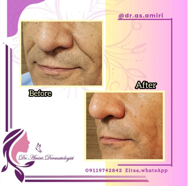 فیلر خط خنده