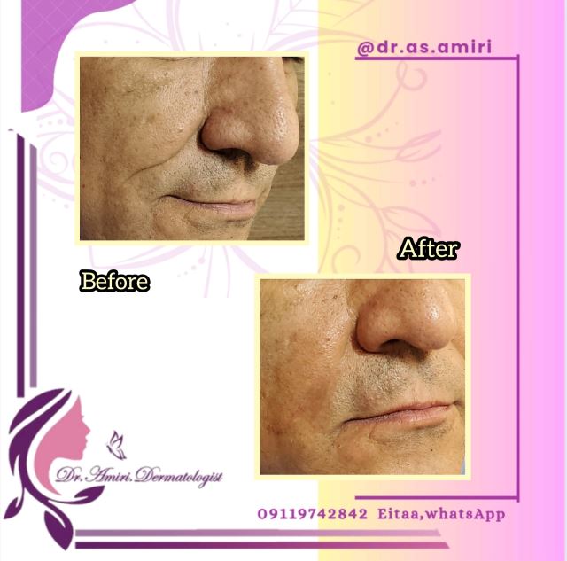 فیلر خط خنده