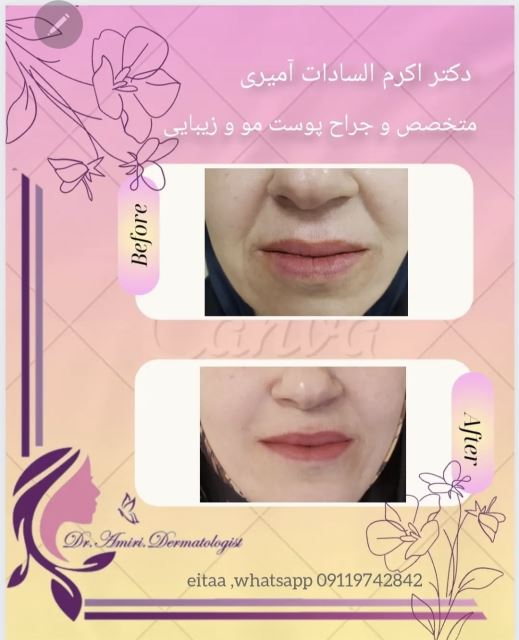 فیلر خط خنده