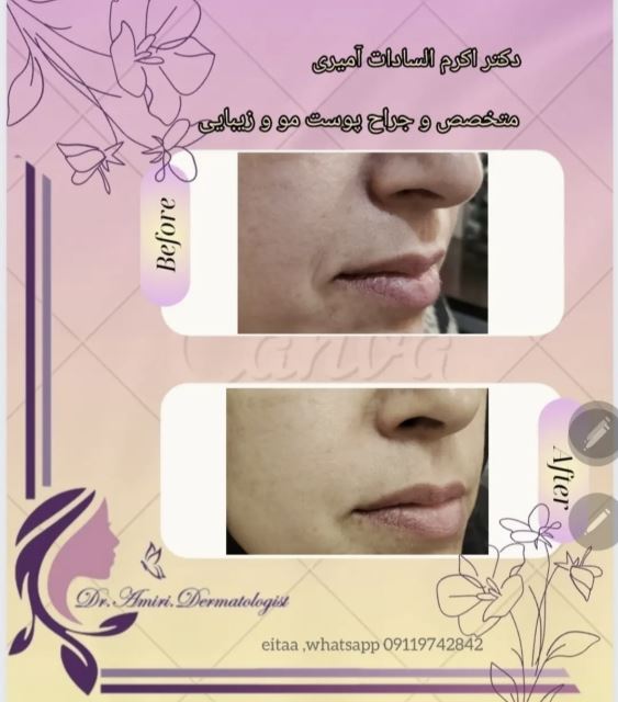 فیلر خط خنده