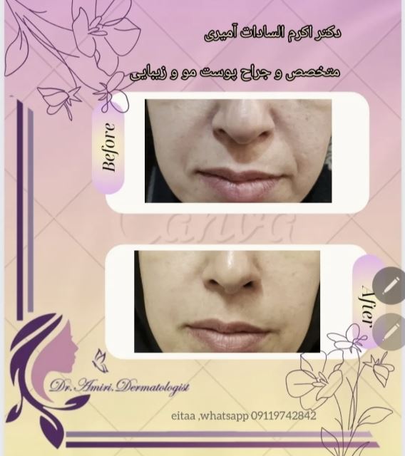 فیلر خط خنده