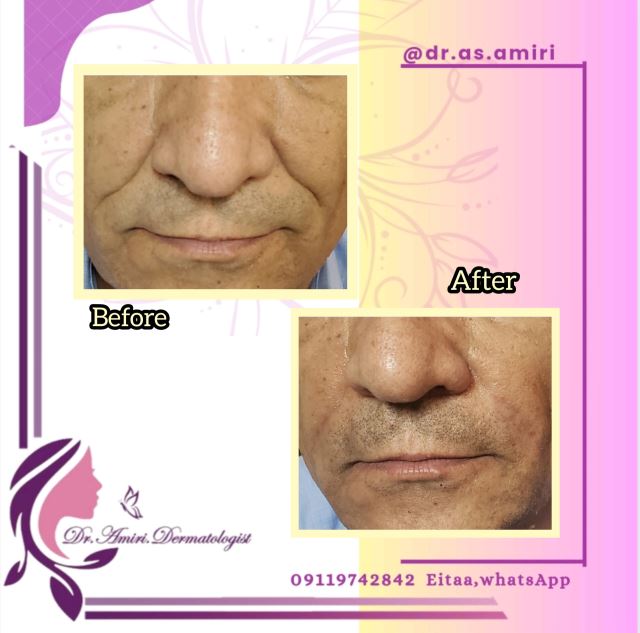 فیلر خط خنده