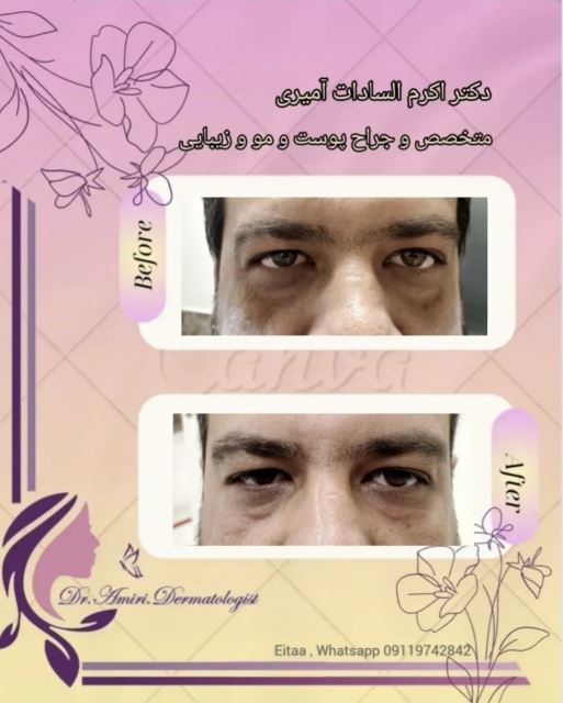 لیزر جوانسازی دور چشم