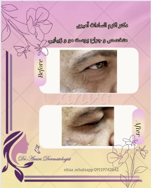 جوانسازی دور چشم