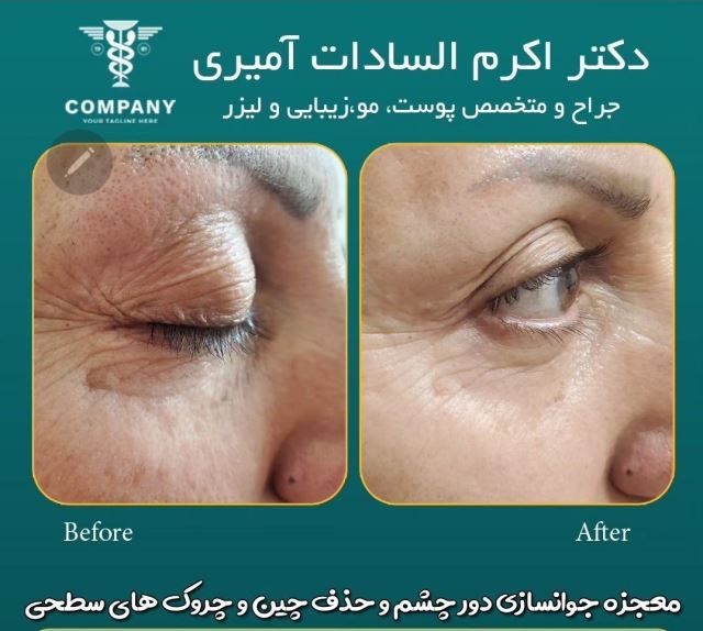 جوانسازی دور چشم